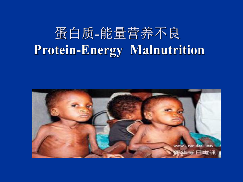 儿科蛋白质-能量营养不良PEM_第1页