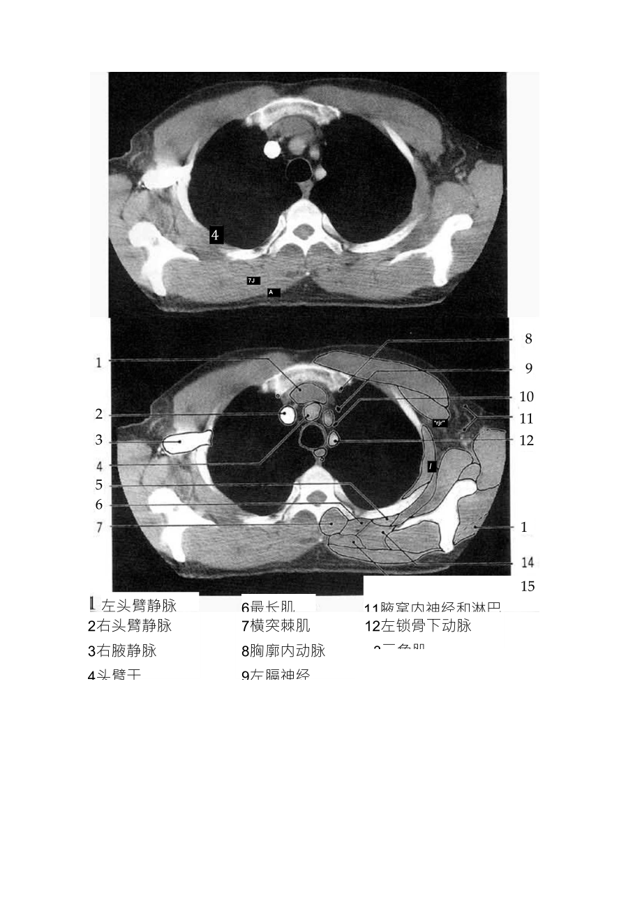 胸部CT解剖(软组织窗)_第1页