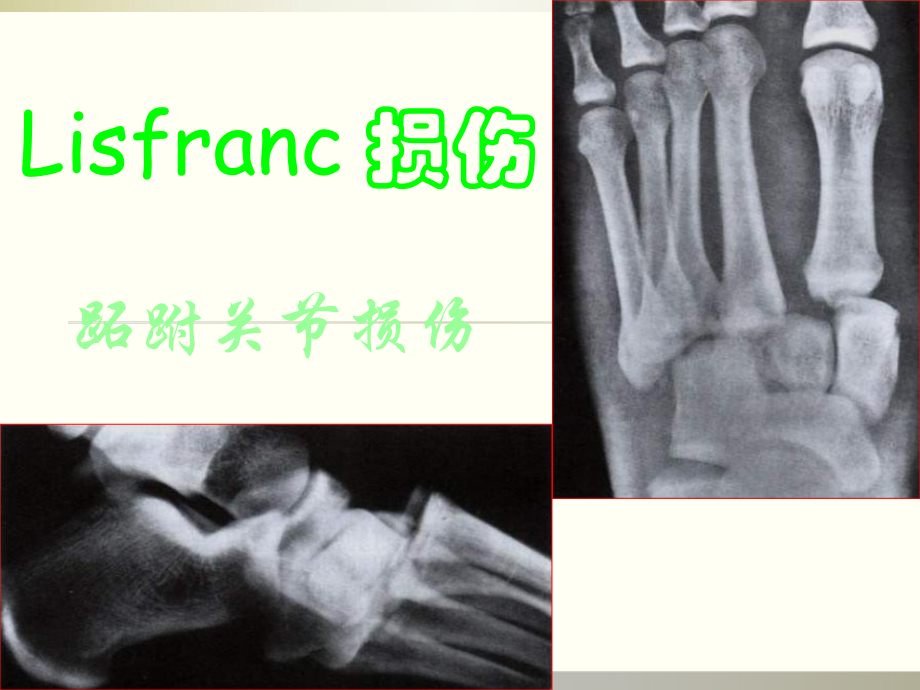 Lisfrance关节损伤PPT课件02_第1页